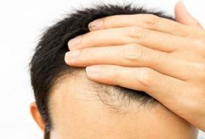 ردپای کرونا در ریزش مو